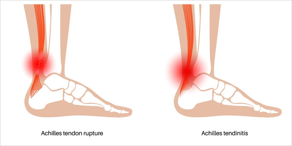 Jenis Cedera Tendon Achilles