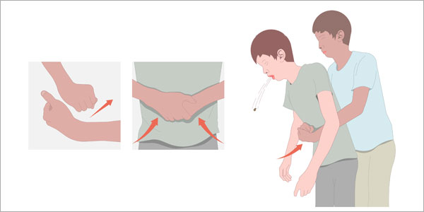Gambar Heimlich Maneuver