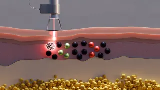 Laser tattoo removal animation thumbnail