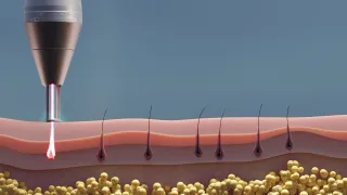 Laser hair removal animation thumbnail