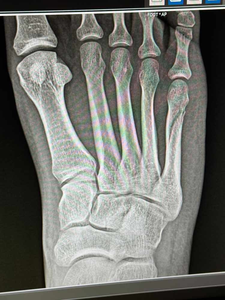 broken bone (real).jpg