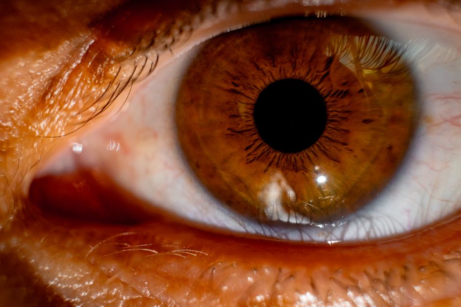 macular degeneration