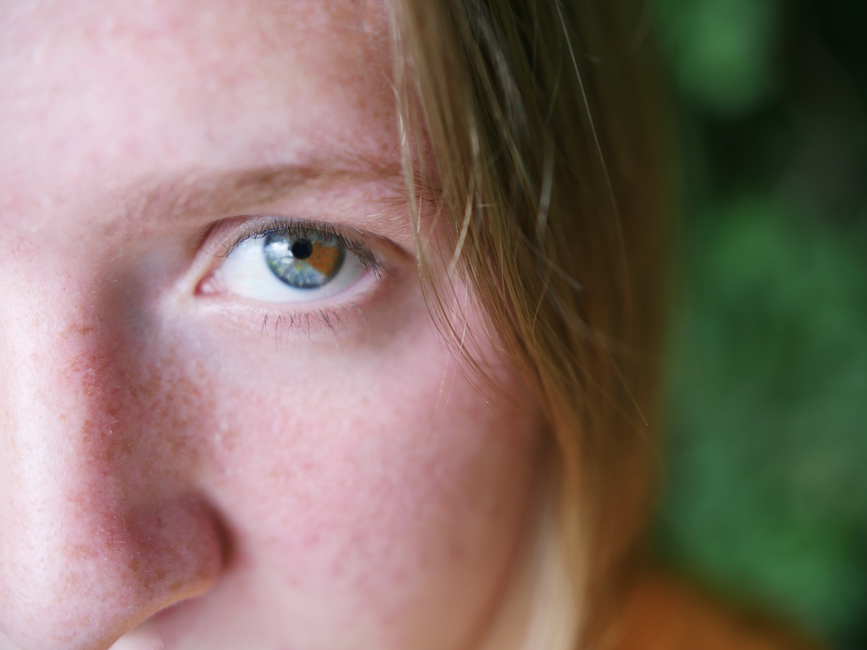 Keratoconus: Why It Starts in Youth