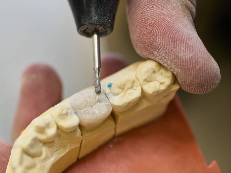 Fogtechnikus finom csiszolófejjel alakítja egy őrlőfog-korona rágófelszínét a gipszmodellen, az Alphadent laborjában