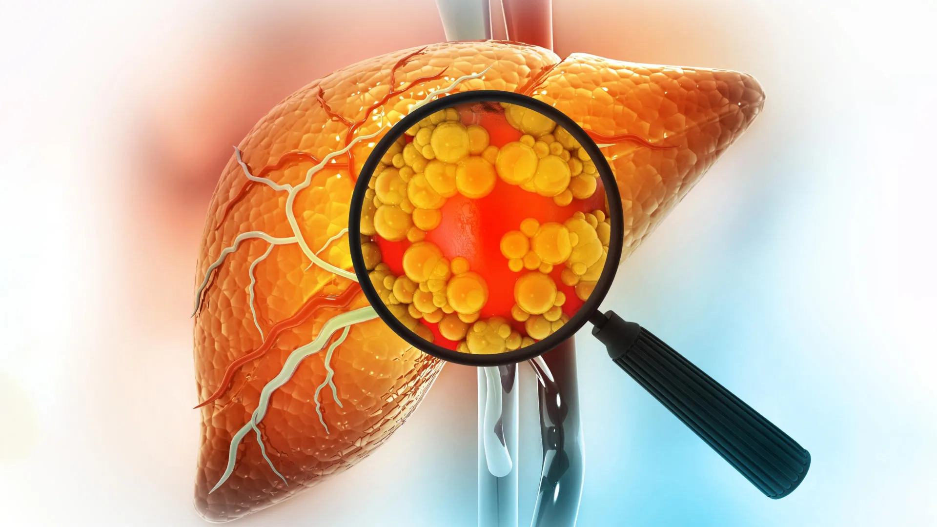 Experimental drug shows promise in reversing fatty liver disease through gut repair