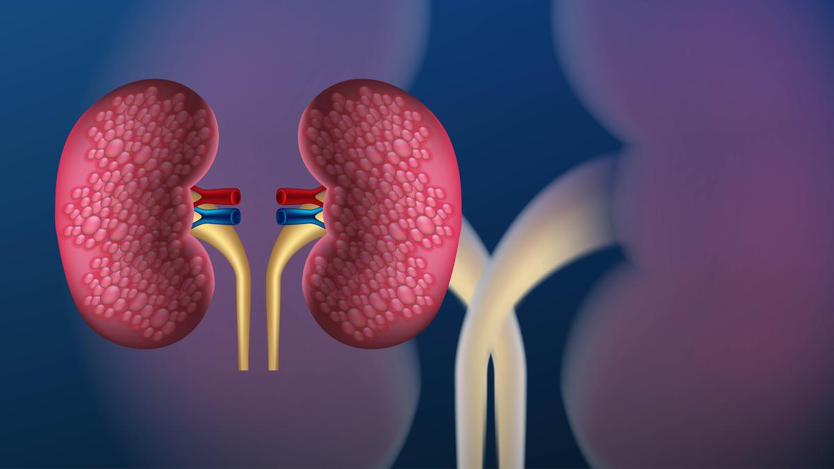 Global CKD Diagnosis Crisis: Over 400 Million Cases Remain Undiagnosed, Warns Lancet Study