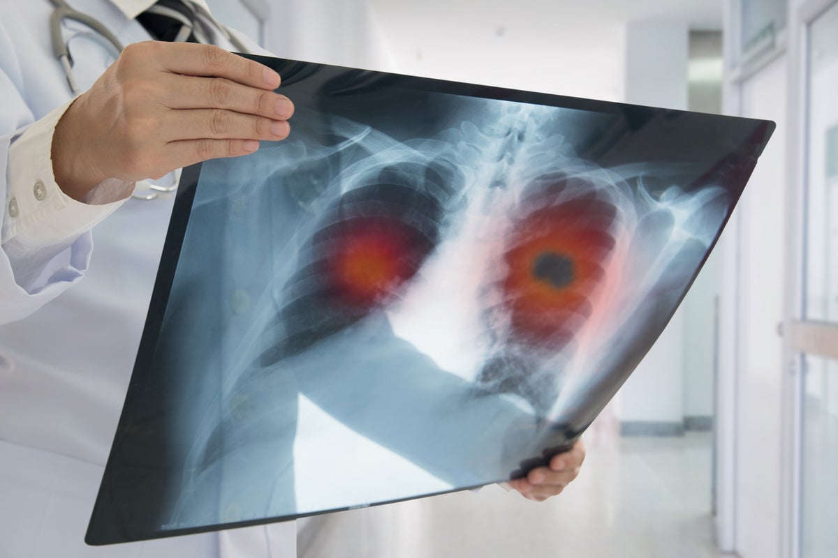 New NHS Lung Preservation Machine Could Boost Transplant Success Rates