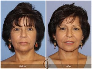 Before and After 1