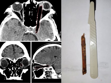 Нейрохирурги Ставропольской краевой клинической больницы извлекли из полости черепа пациентки вонзившийся в глаз 8- сантиметровый обломок ветки