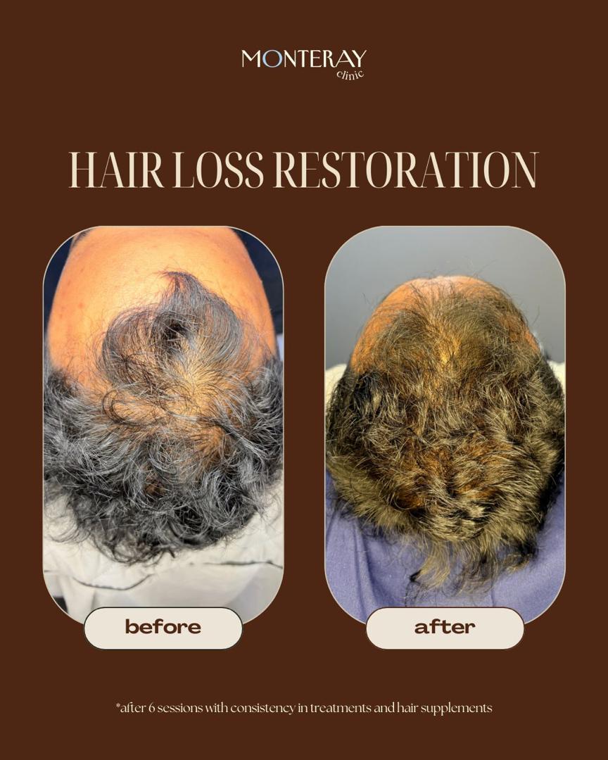 Hair Restoration