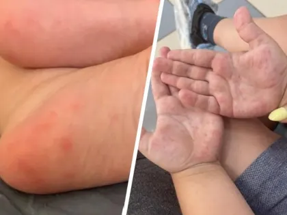 Как распознать инфекцию Коксаки и защитить детей