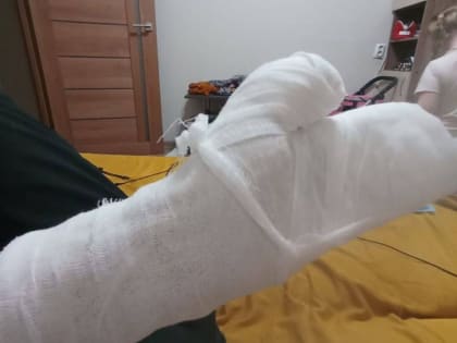 Волшебная палочка чуть не оставила ростовчанку без руки