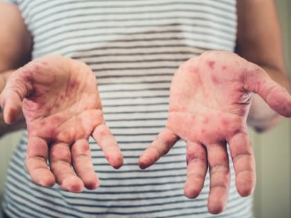 Роспотребнадзор по Ростовской области зарегистрировал три случая энтеровирусной инфекции