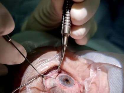Спасение зрения: офтальмологи Ростова вернули женщине глаз