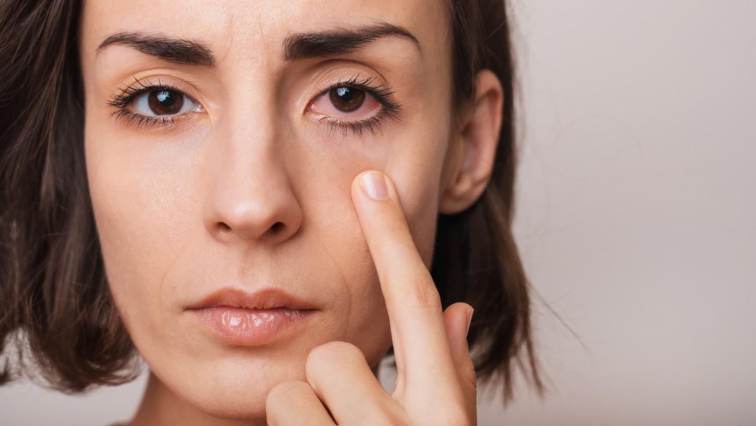 Dry Eyes vs Eye Allergies: What's the Difference?