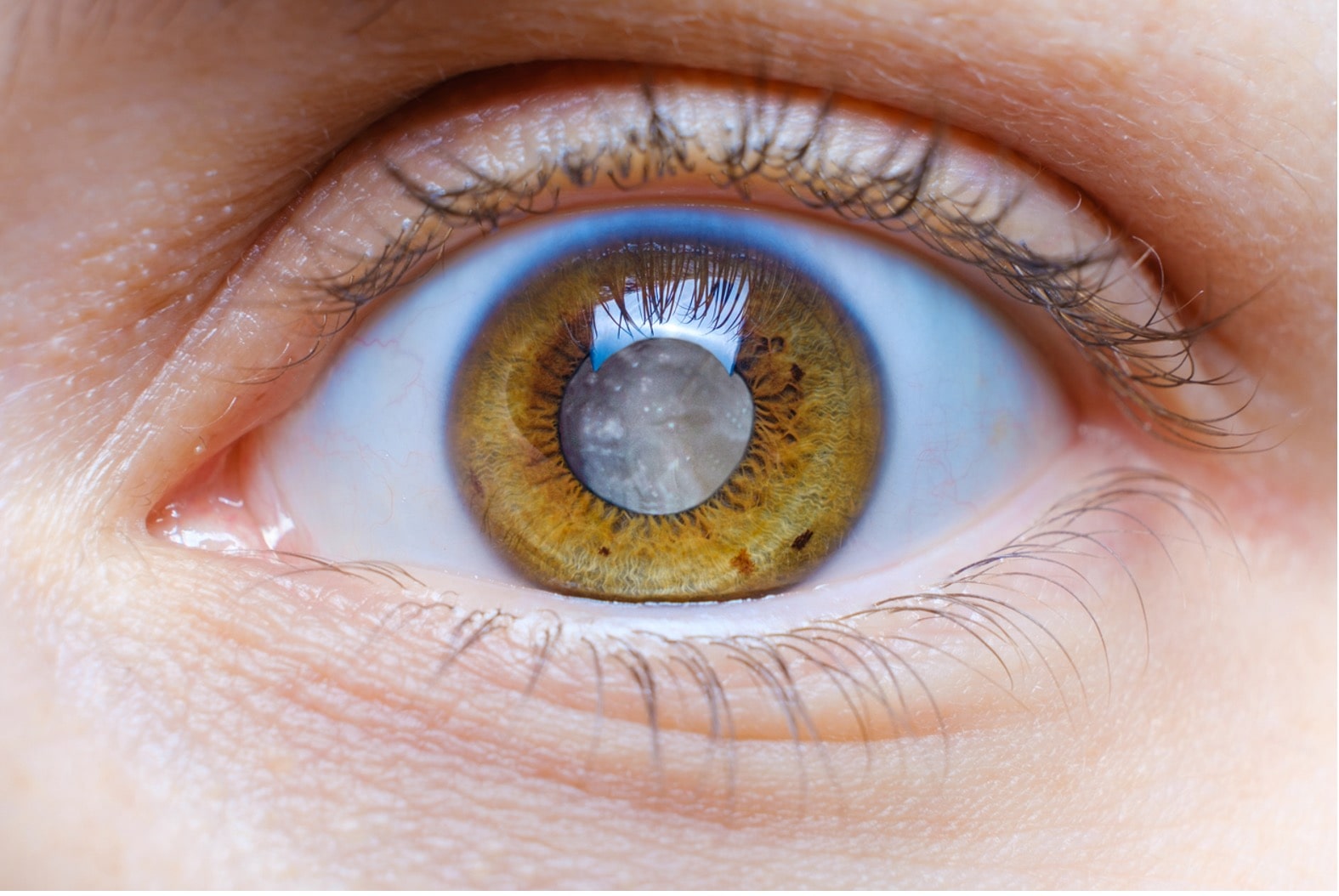 When Should You Get Cataract Surgery? — A Guide by OptiHaven Eye Clinic