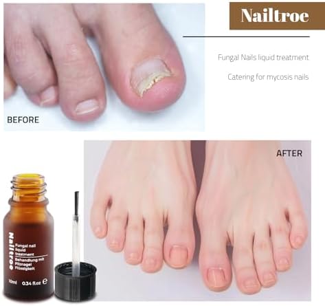 Vue 4 de Mycose Ongles Des Pieds