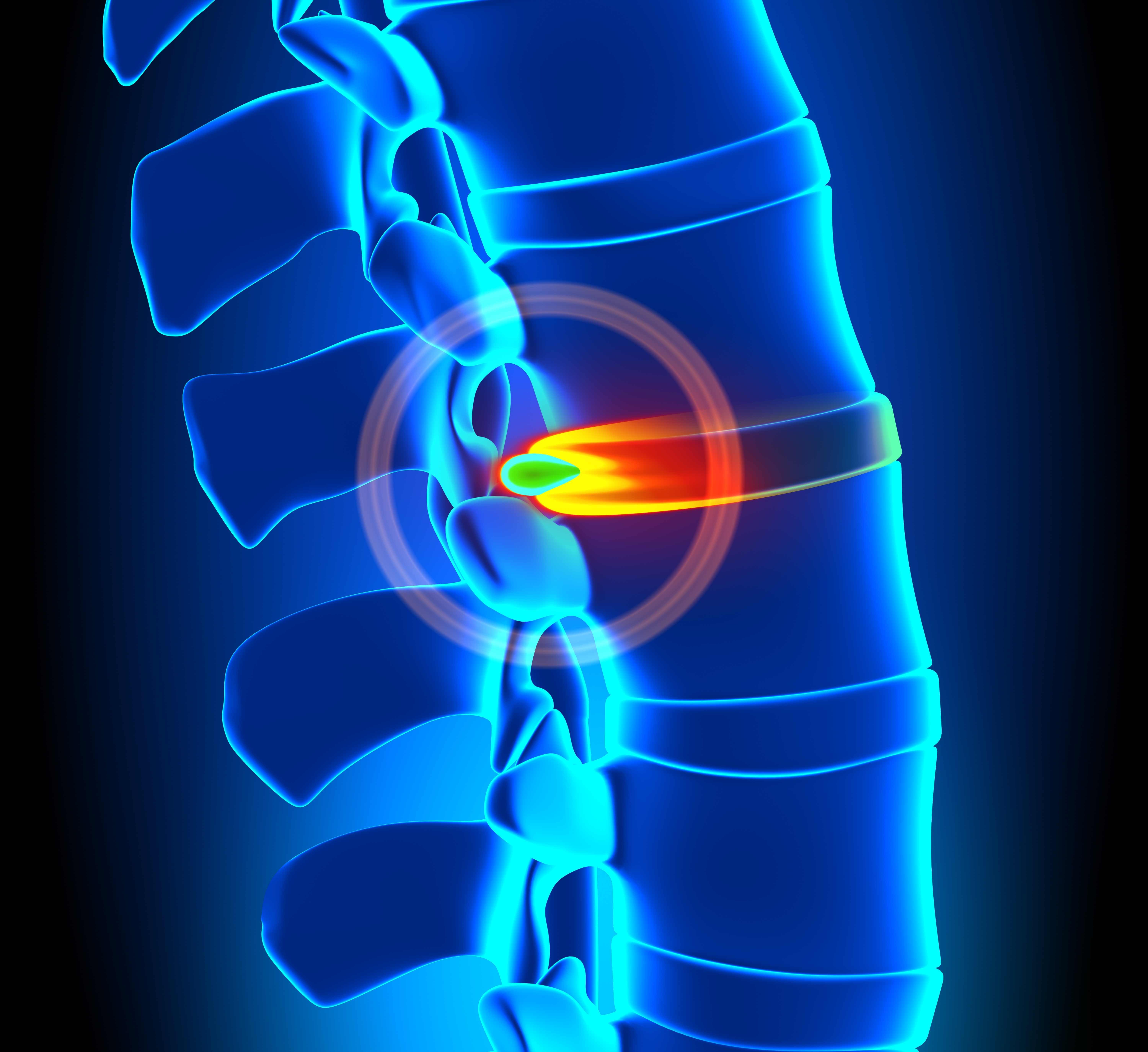 Claims Relating to John Hutchinson Spinal Surgeon
