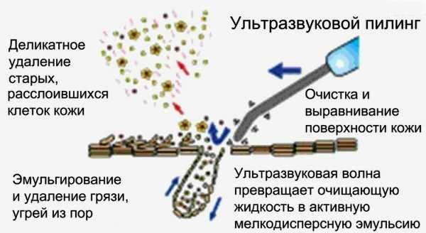 уьтразвуковая чистка