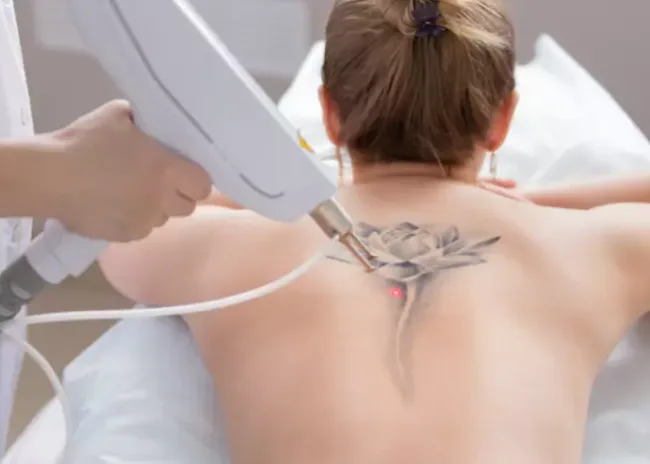 Rimozione Tatuaggi Dr Turco Torino