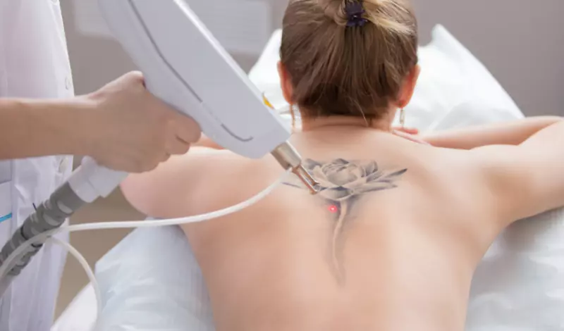 Rimozione Tatuaggi Dr Turco Torino