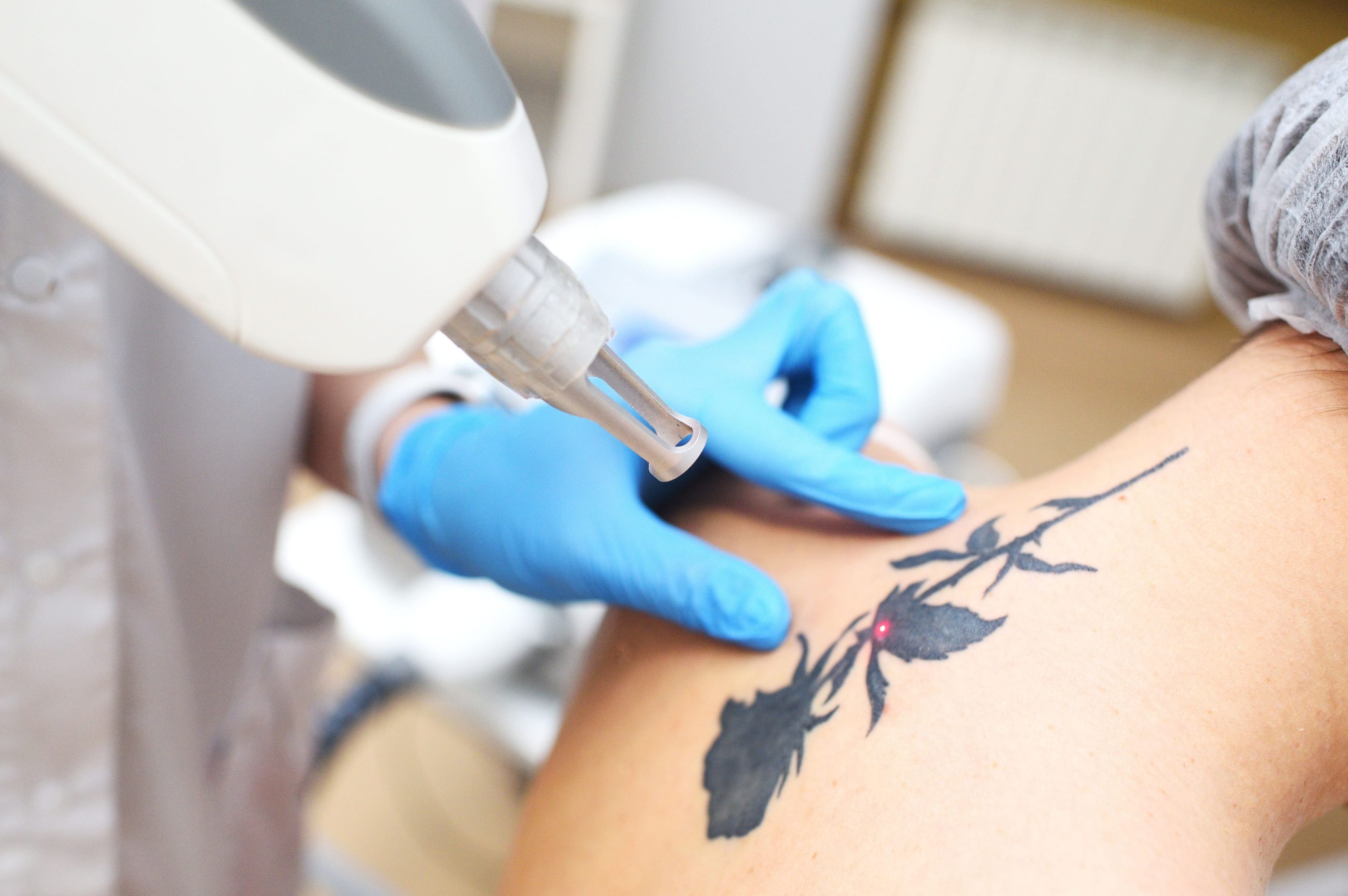 Rimozione Tatuaggi Dr Turco Torino