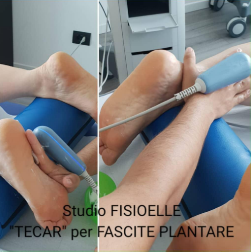 3 o 5 sedute di tecarterapia