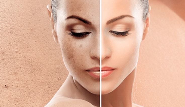 viso peel plasma trattamento urban medical beauty roma -50%