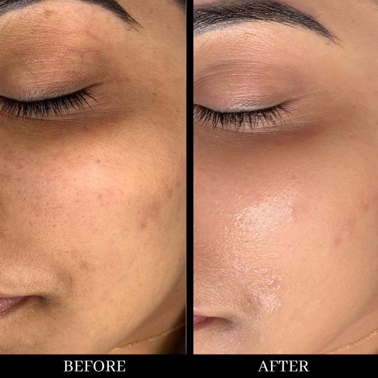 Facial treatment before after - Best unisex salon in Gaya