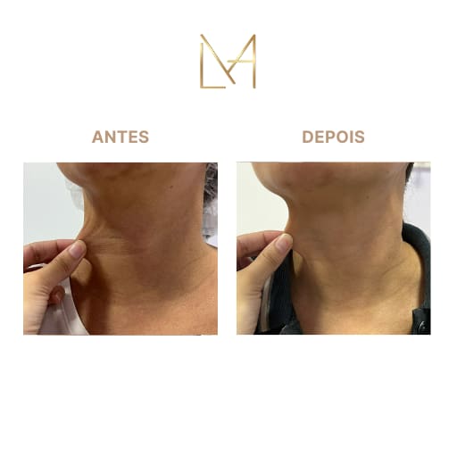 Resultado 2 para Bioestimulador de Colágeno