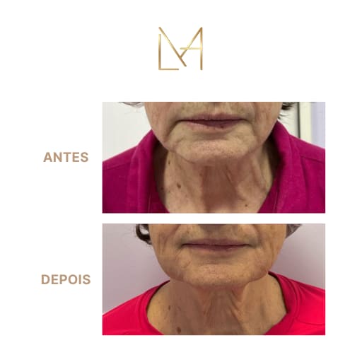 Resultado 3 para Bioestimulador de Colágeno