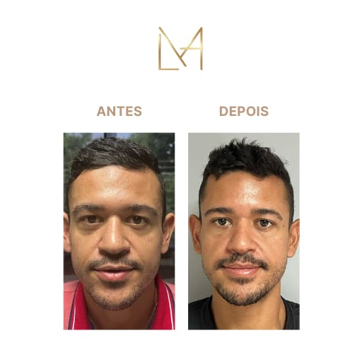 Resultado 1 para Bioestimulador de Colágeno