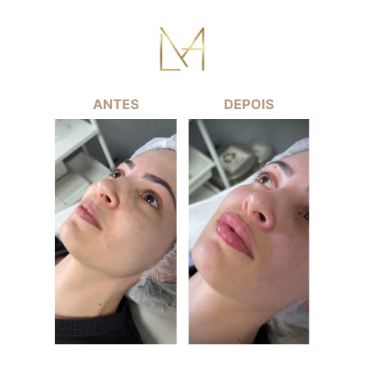 Resultado 1 para Preenchimento Labial