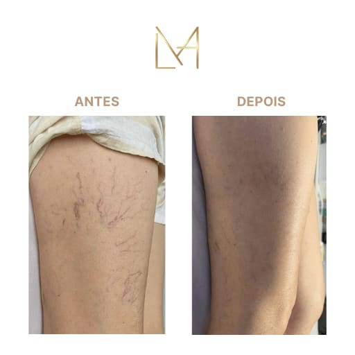 Resultado 1 para Secagem de Microvaso