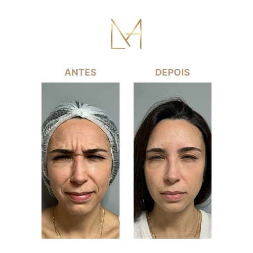 Resultado 1 para Toxina Botulínica