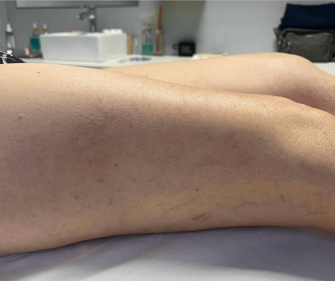 Secagem de Microvaso