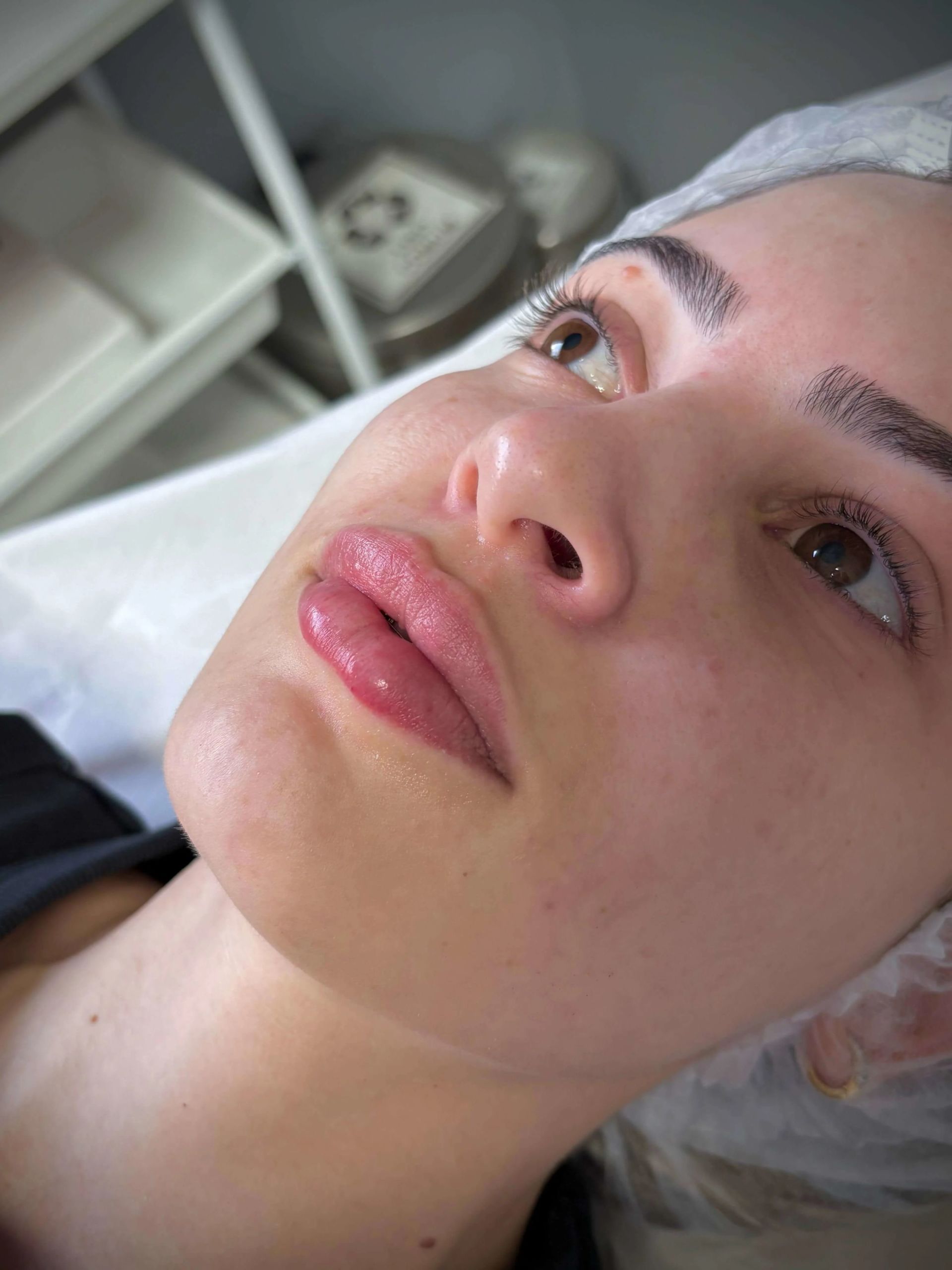 Preenchimento Labial