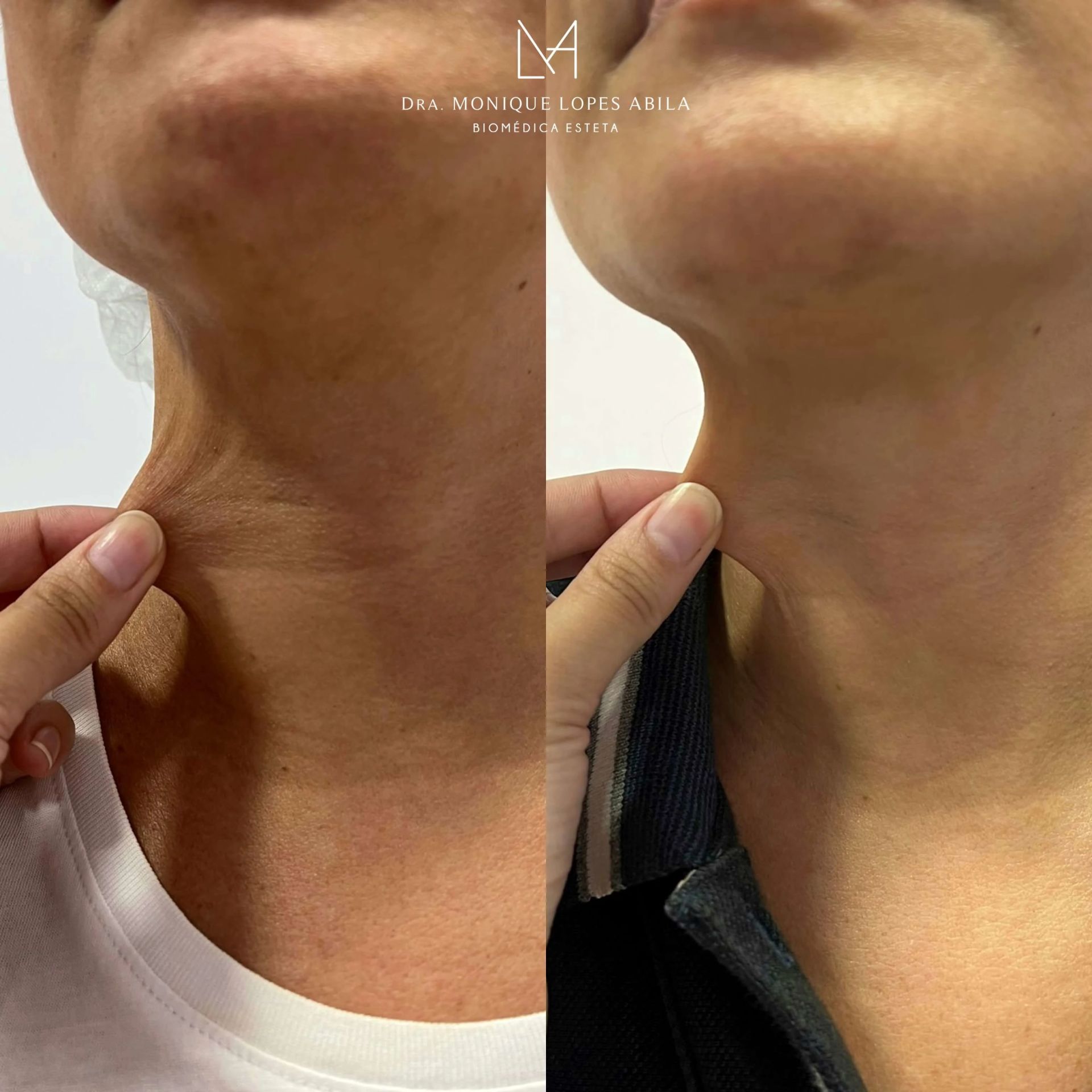 Bioestimuladores de Colágeno