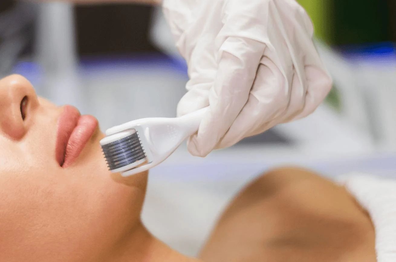 Microagulhamento com peeling químico