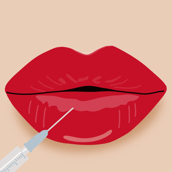 4 Key Things All First-Timers Should Know Before Trying Lip Fillers Illustration of lip injections