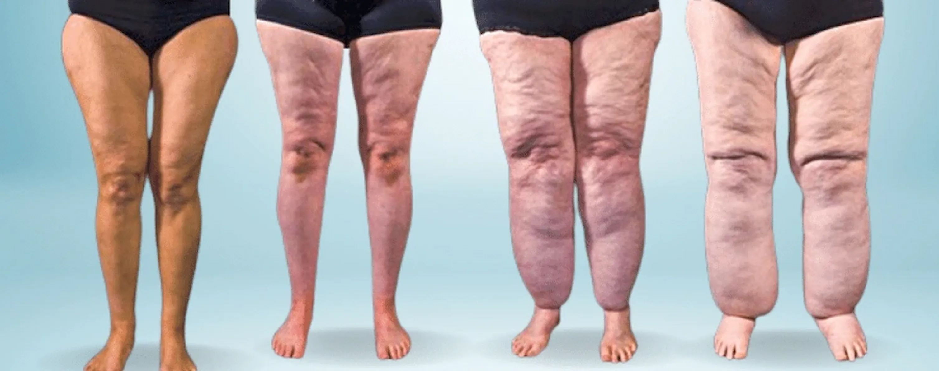 Lipedema: o que é, como diagnosticar e o papel da Nutricionista no tratamento