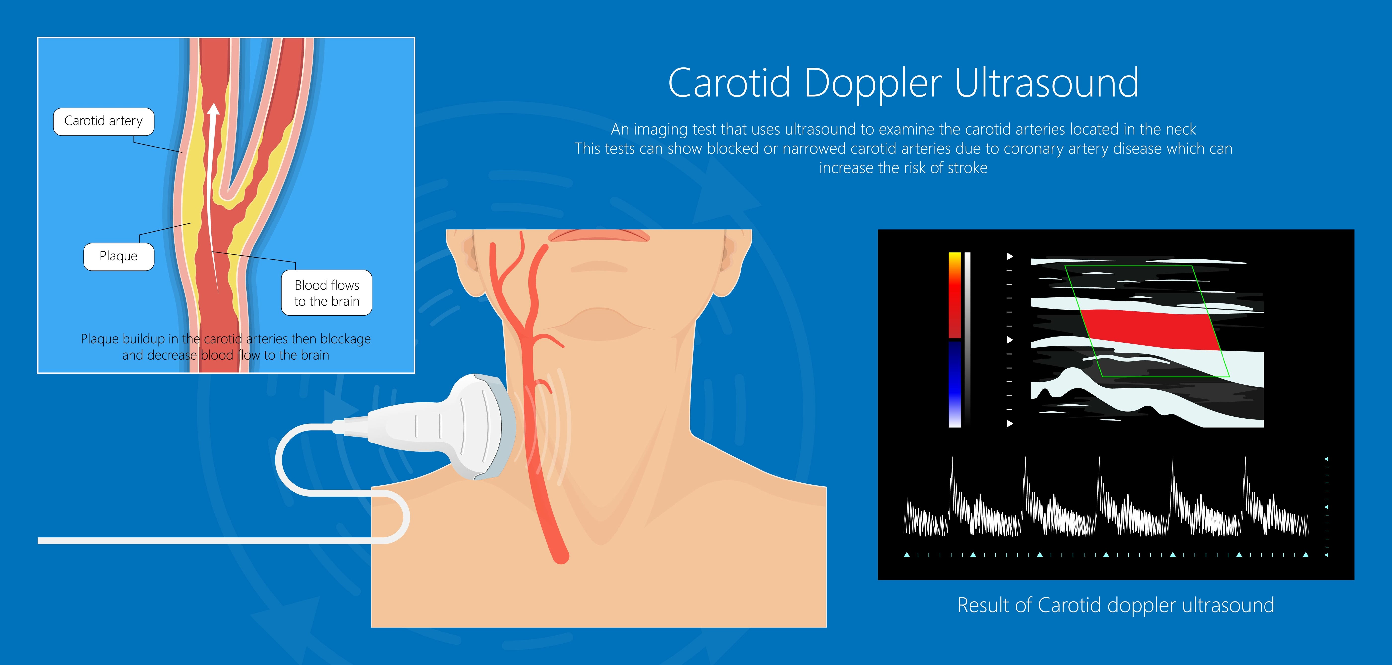 ultrazvuk-color-doppler-žila-vrata