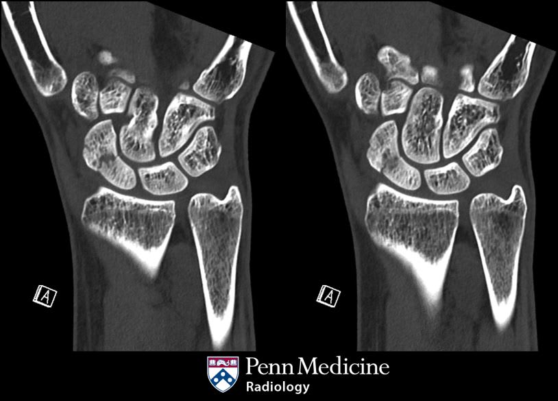 25-year-old woman with wrist pain - Auntminnie
