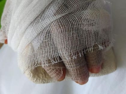 В Ростове врачи спасли женщине-кондитеру отрубленную гильотиной кисть руки