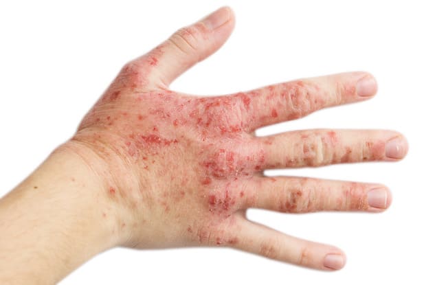 a red rash of eczema on a person’s hand