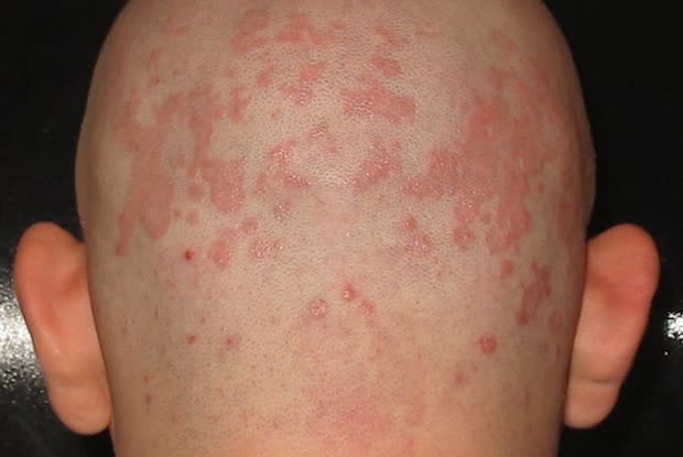 a splotchy rash of Seborrheic Dermatitis on a person’s scalp