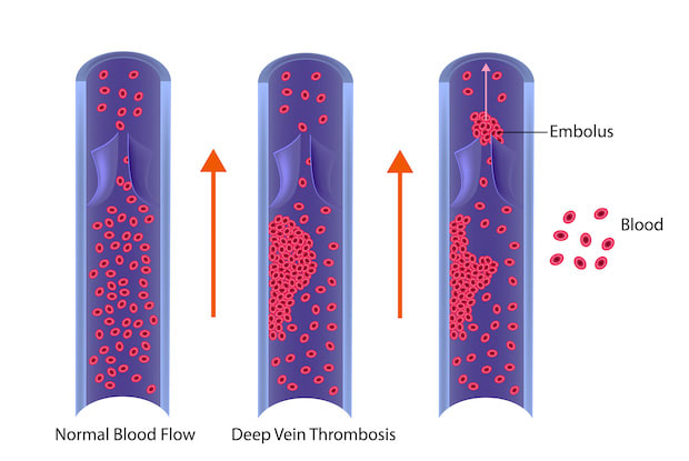 a graphic explaining deep vein thrombosis