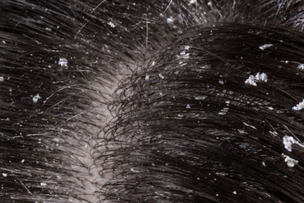 a close up view of dandruff flakes in black hair