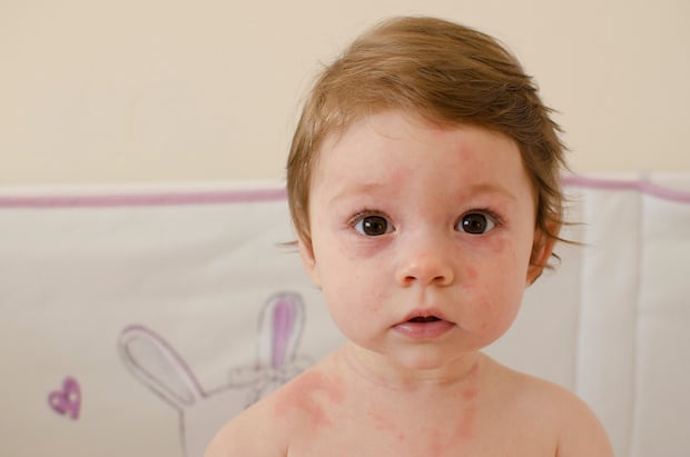 a toddler displaying symptoms of roseola