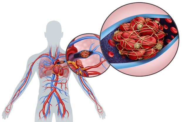 anatomy of a pulmonary embolism